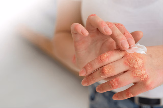 Leprosy In India: The Road To A Disease-Free Future