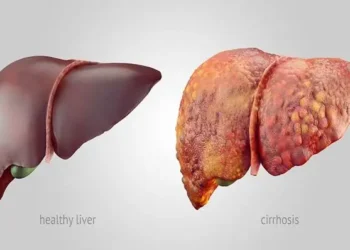 Fatty liver affects 23-30% of Kashmir’s population: Dr Wahid Akbar
