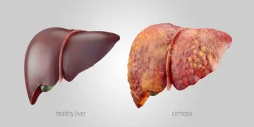 Fatty liver affects 23-30% of Kashmir’s population: Dr Wahid Akbar