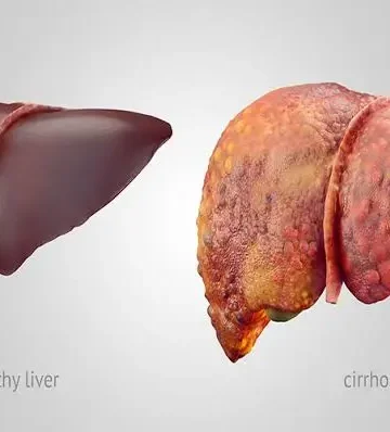 Fatty liver affects 23-30% of Kashmir’s population: Dr Wahid Akbar